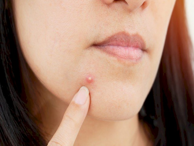 Pimple Hacks: पिंपल्स से चाहिए छुट्टी, तो   अपनाएं इन घरेलू नुस्खों को